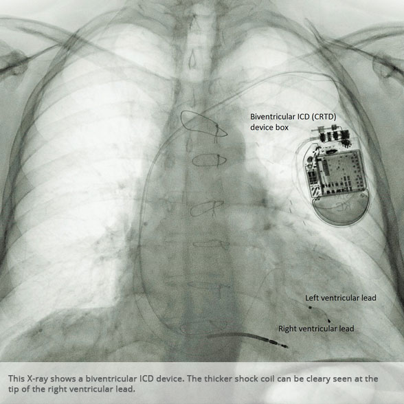 Biventricular ICD (CRTD)