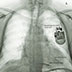 Biventricular ICD (CRTD)